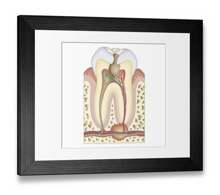 Framed Print : Cross section biomedical illustration of pulp and root abscess in molar Framed Print : Cross section biomedical illustration of pulp and root abscess in molar