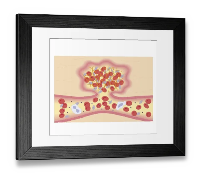 Framed Print : Cross section biomedical illustration of formation of blood clot by protein fibrogen converting into insoluble fibrin strands Framed Print : Cross section biomedical illustration of formation of blood clot by protein fibrogen converting into insoluble fibrin strands