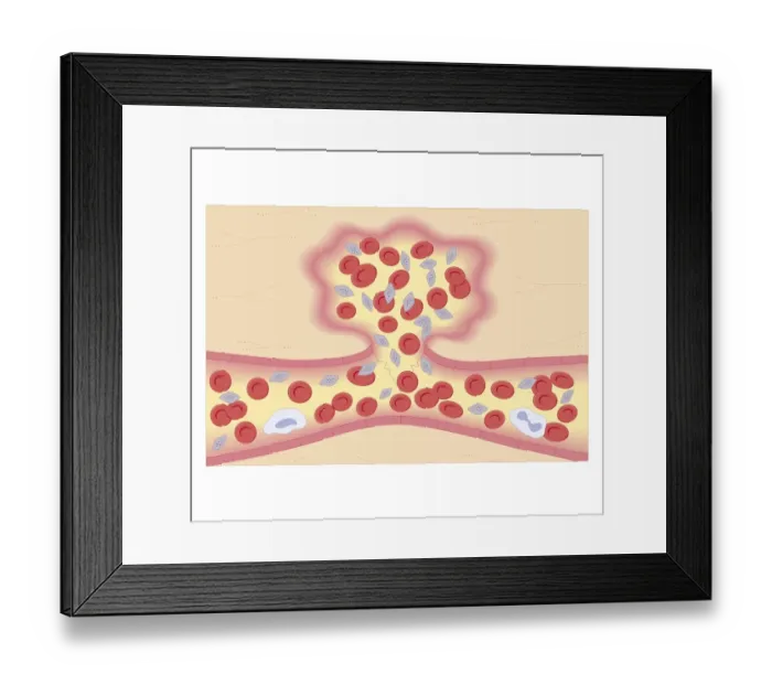 Framed Print : Cross section biomedical illustration of formation of blood clot with damaged blood vessel constricting and platelets are activated and adhere to the blood vessel wall Framed Print : Cross section biomedical illustration of formation of blood clot with damaged blood vessel constricting and platelets are activated and adhere to the blood vessel wall
