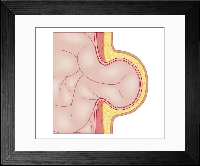 Framed Print : Cross section biomedical illustration of development of hernia Framed Print : Cross section biomedical illustration of development of hernia