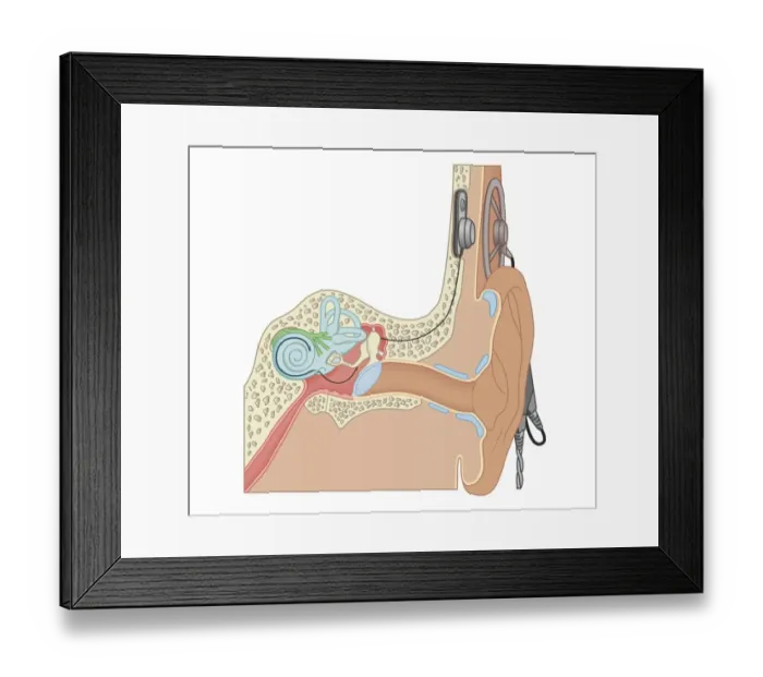 Framed Print : Cross section biomedical illustration of cochlear implants Framed Print : Cross section biomedical illustration of cochlear implants