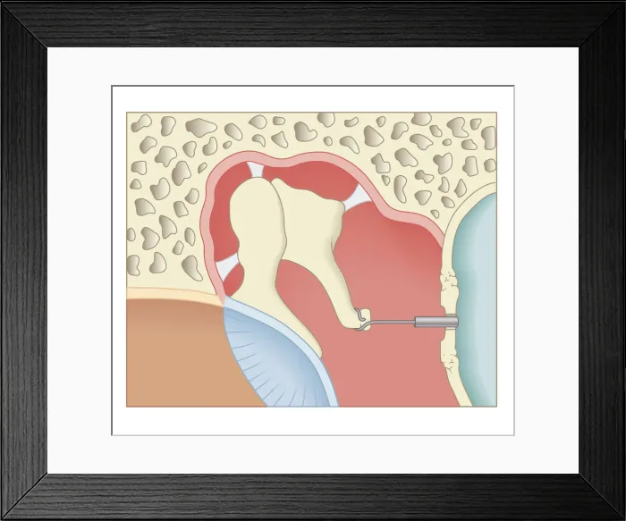 Framed Print : Cross section biomedical illustration of post-operative stapedotomy surgery Framed Print : Cross section biomedical illustration of post-operative stapedotomy surgery