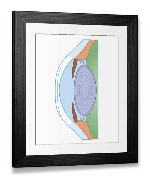 Framed Print : Cross section biomedical illustration of human eye before corrective surgery for myopia Framed Print : Cross section biomedical illustration of human eye before corrective surgery for myopia