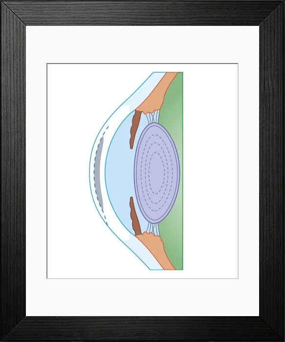 Framed Print : Cross section biomedical illustration of human eye before corrective surgery for myopia Framed Print : Cross section biomedical illustration of human eye before corrective surgery for myopia