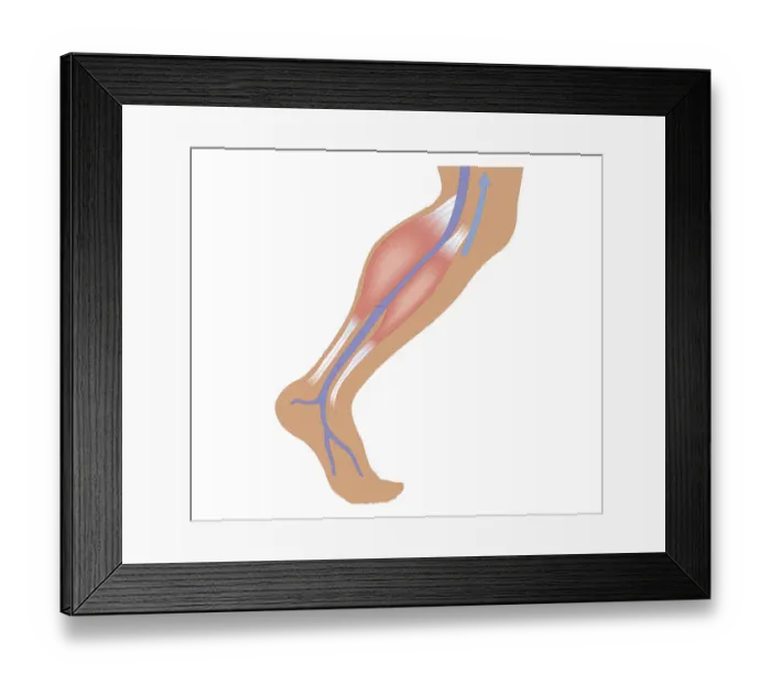 Framed Print : Cross section biomedical illustration of calf muscle contraction constricting femoral artery in human leg Framed Print : Cross section biomedical illustration of calf muscle contraction constricting femoral artery in human leg