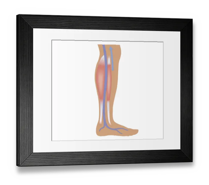 Framed Print : Cross section biomedical illustration of relaxed calf muscle and femoral artery in human leg Framed Print : Cross section biomedical illustration of relaxed calf muscle and femoral artery in human leg