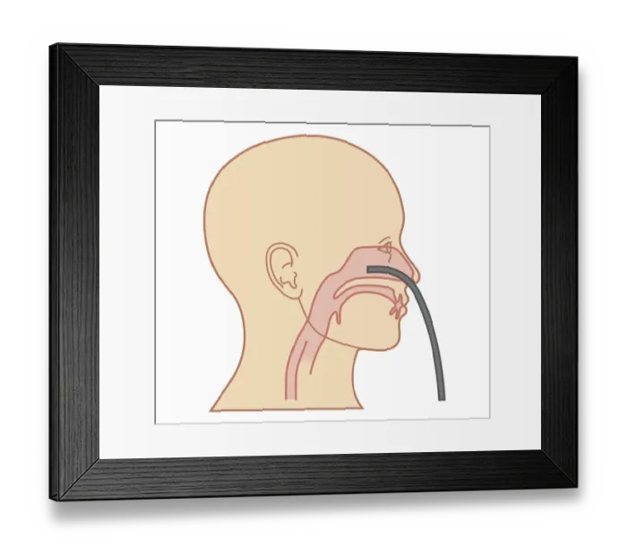 Framed Print : Cross section biomedical illustration of endoscope inserted through nose for Anterior Rhinoscopy procedure Framed Print : Cross section biomedical illustration of endoscope inserted through nose for Anterior Rhinoscopy procedure
