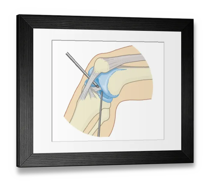 Framed Print : Cross section biomedical illustration of inside the knee joint during rigid endoscopy procedure Framed Print : Cross section biomedical illustration of inside the knee joint during rigid endoscopy procedure