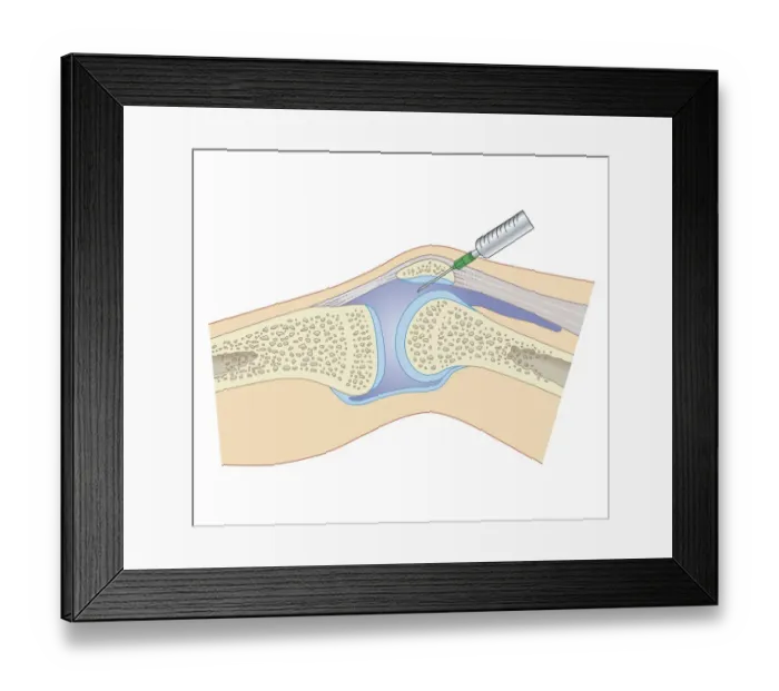 Framed Print : Cross section biomedical illustration of removing synovial fluid from knee using joint aspiration Framed Print : Cross section biomedical illustration of removing synovial fluid from knee using joint aspiration