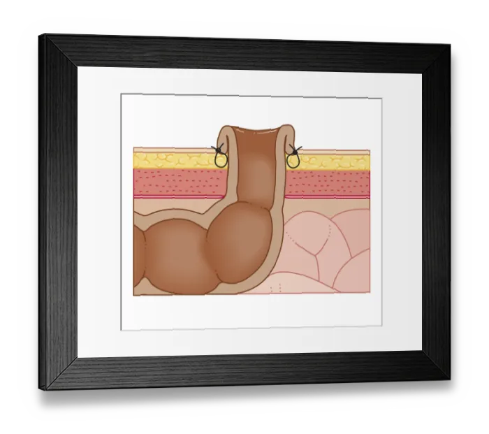 Framed Print : Cross section biomedical illustration of permanent colostomy with colon sutured to abdominal wall Framed Print : Cross section biomedical illustration of permanent colostomy with colon sutured to abdominal wall