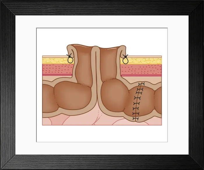 Framed Print : Cross section biomedical illustration of temporary colostomy Framed Print : Cross section biomedical illustration of temporary colostomy