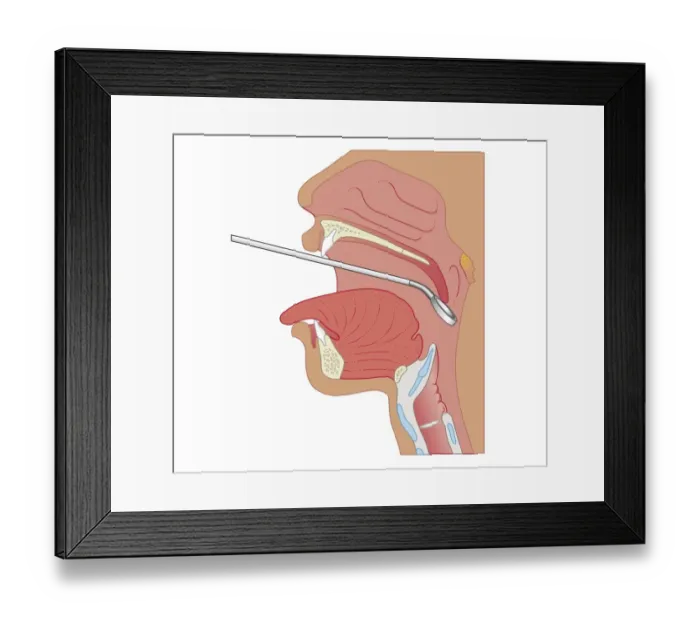 Framed Print : Cross section biomedical illustration of mirror laryngoscopy Framed Print : Cross section biomedical illustration of mirror laryngoscopy