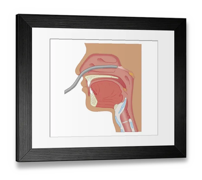 Framed Print : Cross section biomedical illustration of endoscopy of the nose and throat Framed Print : Cross section biomedical illustration of endoscopy of the nose and throat