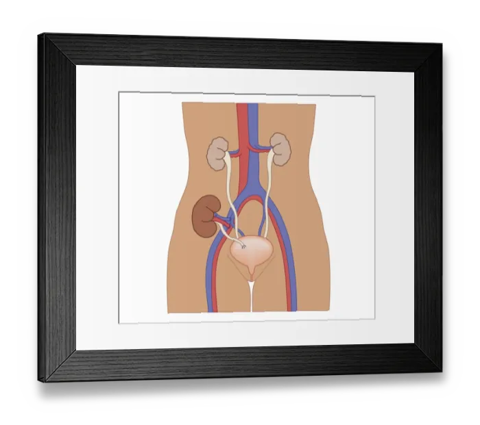 Framed Print : Cross section biomedical illustration of kidney transplant