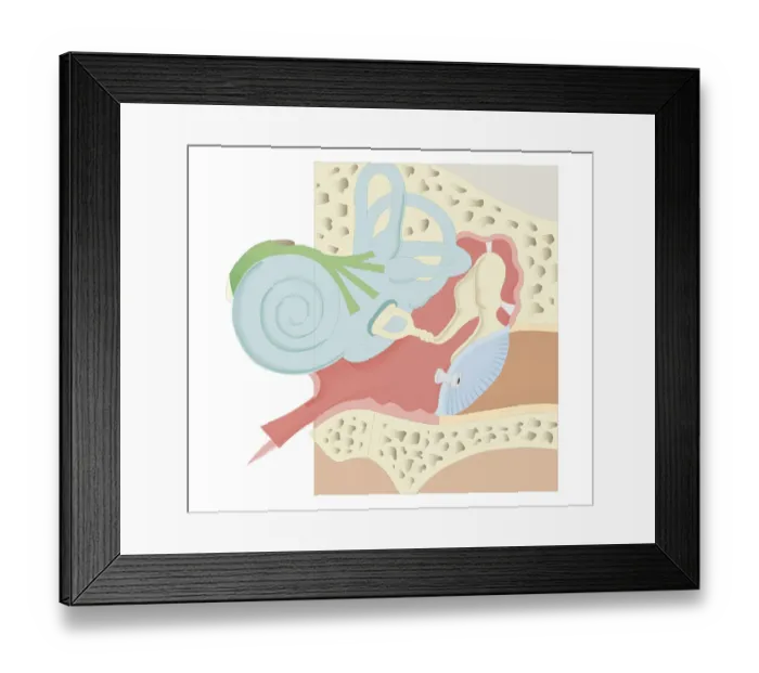 Framed Print : Cross section biomedical illustration of grommet inserted in eardrum (tympanic membrane) Framed Print : Cross section biomedical illustration of grommet inserted in eardrum (tympanic membrane)