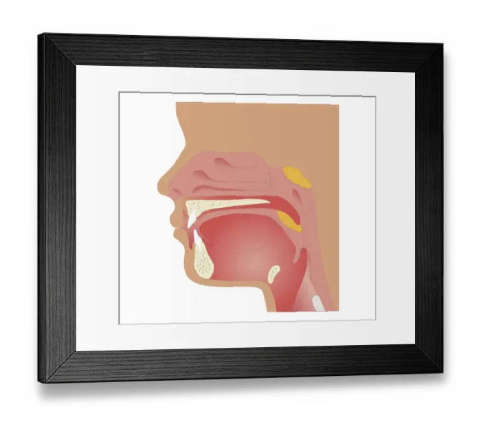 Framed Print : Cross section biomedical illustration of sites of tonsilectomy and adenoidectomy procedures Framed Print : Cross section biomedical illustration of sites of tonsilectomy and adenoidectomy procedures
