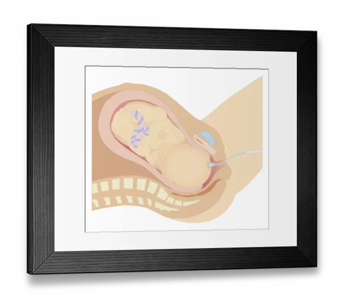 Framed Print : Cross section biomedical illustration of internal foetal monitoring prior to birth