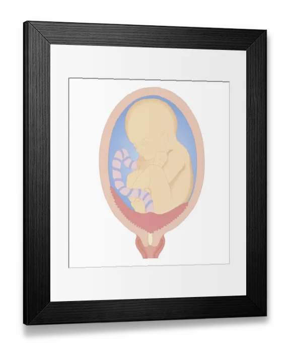 Framed Print : Cross section biomedical illustration of complete placenta praevia Framed Print : Cross section biomedical illustration of complete placenta praevia
