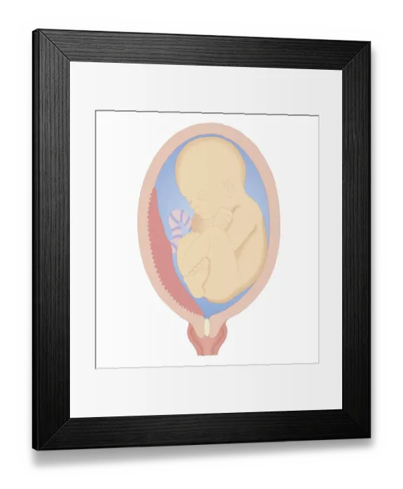 Framed Print : Cross section biomedical illustration of marginal placenta praevia Framed Print : Cross section biomedical illustration of marginal placenta praevia