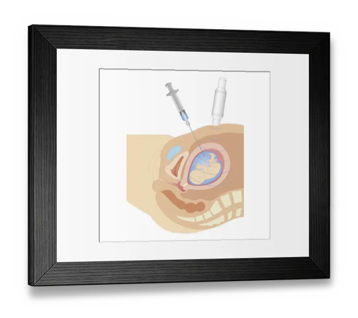 Framed Print : Cross section biomedical illustration of amniocentesis procedure Framed Print : Cross section biomedical illustration of amniocentesis procedure