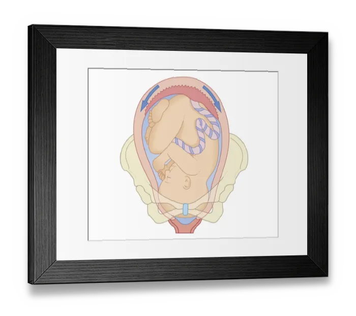 Framed Print : Cross section biomedical illustration of position foetus in pelvis at first stage of labour Framed Print : Cross section biomedical illustration of position foetus in pelvis at first stage of labour