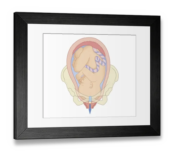 Framed Print : Cross section biomedical illustration of position foetus in pelvis at first stage of labour Framed Print : Cross section biomedical illustration of position foetus in pelvis at first stage of labour