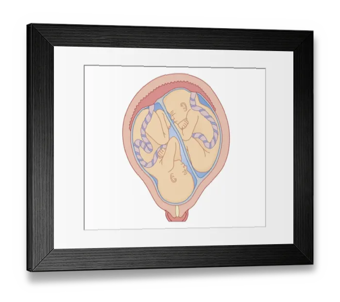 Framed Print : Cross section biomedical illustration of identical twins in uterus sharing placenta Framed Print : Cross section biomedical illustration of identical twins in uterus sharing placenta