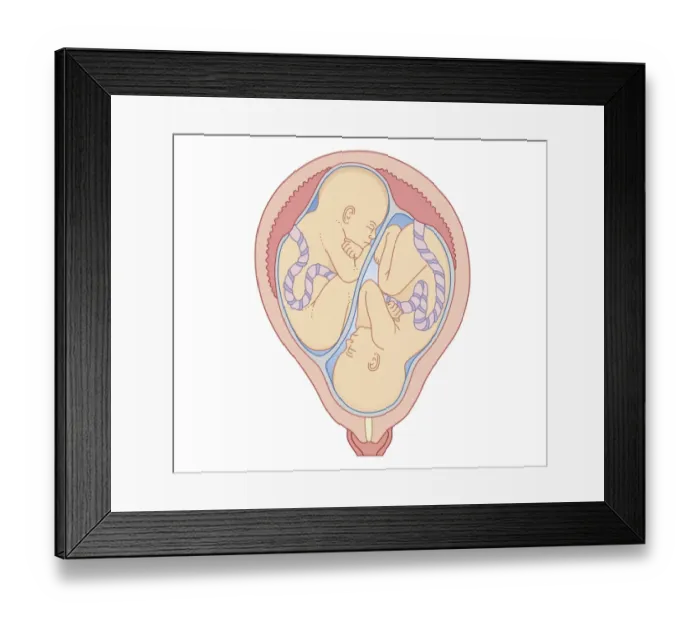 Framed Print : Cross section biomedical illustration of non identical twins in uterus with separate placentas Framed Print : Cross section biomedical illustration of non identical twins in uterus with separate placentas