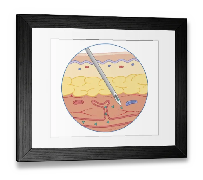 Framed Print : Cross section biomedical illustration of intramuscular drug injected into muscle dispersing into bloodstream Framed Print : Cross section biomedical illustration of intramuscular drug injected into muscle dispersing into bloodstream