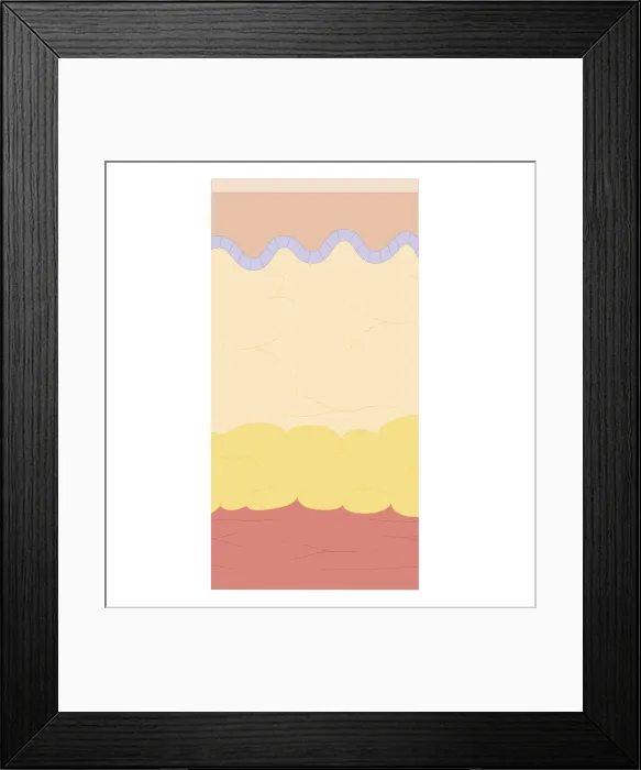 Framed Print : Cross section biomedical illustration of degrees of severity of burns Framed Print : Cross section biomedical illustration of degrees of severity of burns