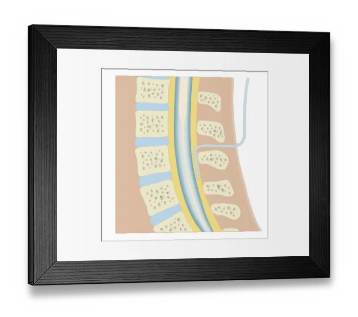Framed Print : Cross section biomedical illustration of epidural anaesthesia during labour Framed Print : Cross section biomedical illustration of epidural anaesthesia during labour