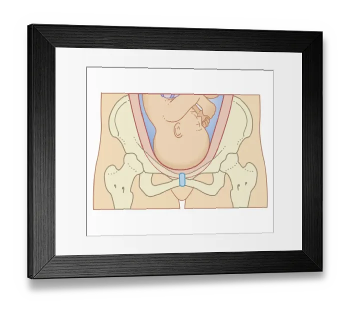 Framed Print : Cross section biomedical illustration of position of head of foetus before engagement process Framed Print : Cross section biomedical illustration of position of head of foetus before engagement process