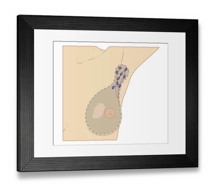 Framed Print : Cross section biomedical illustration of breast cancer tumour and lymph nodes requiring mastectomy procedure Framed Print : Cross section biomedical illustration of breast cancer tumour and lymph nodes requiring mastectomy procedure