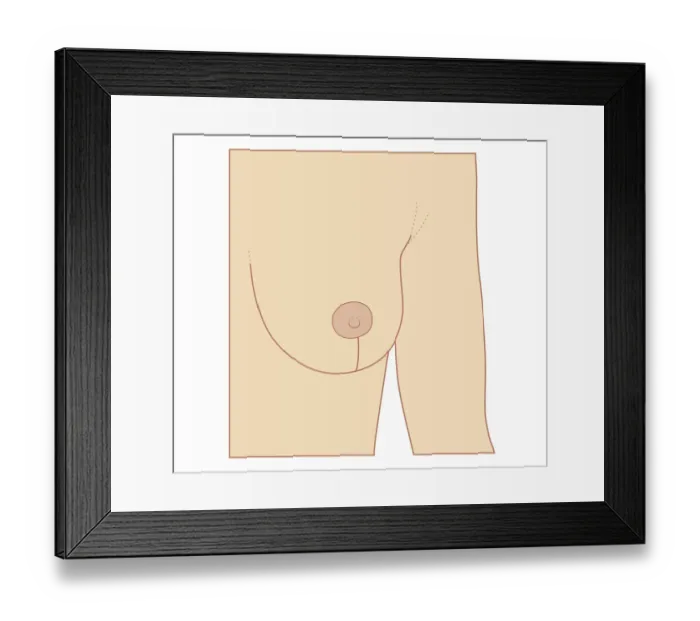 Framed Print : Cross section biomedical illustration of incision site for breast reduction procedure Framed Print : Cross section biomedical illustration of incision site for breast reduction procedure