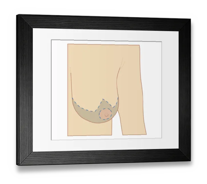 Framed Print : Cross section biomedical illustration of site of breast reduction Framed Print : Cross section biomedical illustration of site of breast reduction