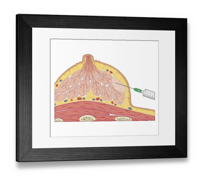 Framed Print : Cross section biomedical illustration of fine needle aspiration of breast lump Framed Print : Cross section biomedical illustration of fine needle aspiration of breast lump