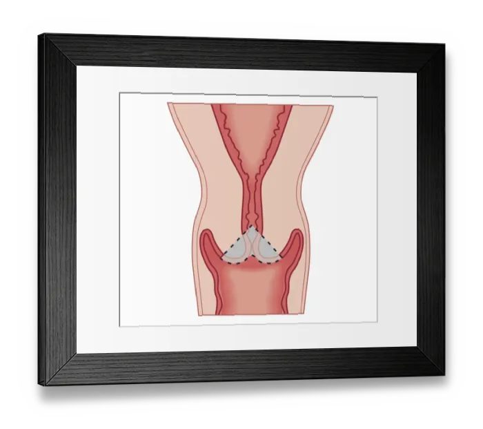 Framed Print : Cross section biomedical illustration of Cervical conization biopsy of cervical intraepithelial neoplasia Framed Print : Cross section biomedical illustration of Cervical conization biopsy of cervical intraepithelial neoplasia