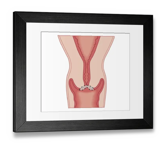 Framed Print : Cross section biomedical illustration of treating cervical intraepithelial neoplasia with large loop excision of the transformation zone (LLETZ) Framed Print : Cross section biomedical illustration of treating cervical intraepithelial neoplasia with large loop excision of the transformation zone (LLETZ)