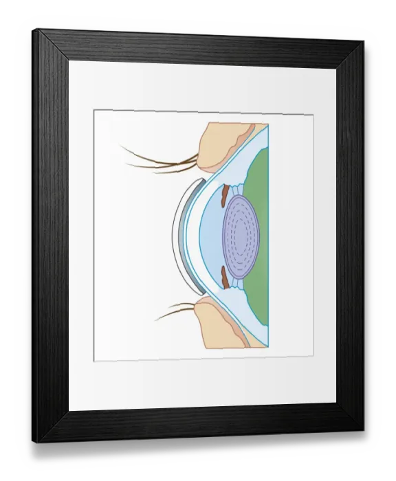 Framed Print : Cross section biomedical illustration of soft contact lens on eye Framed Print : Cross section biomedical illustration of soft contact lens on eye