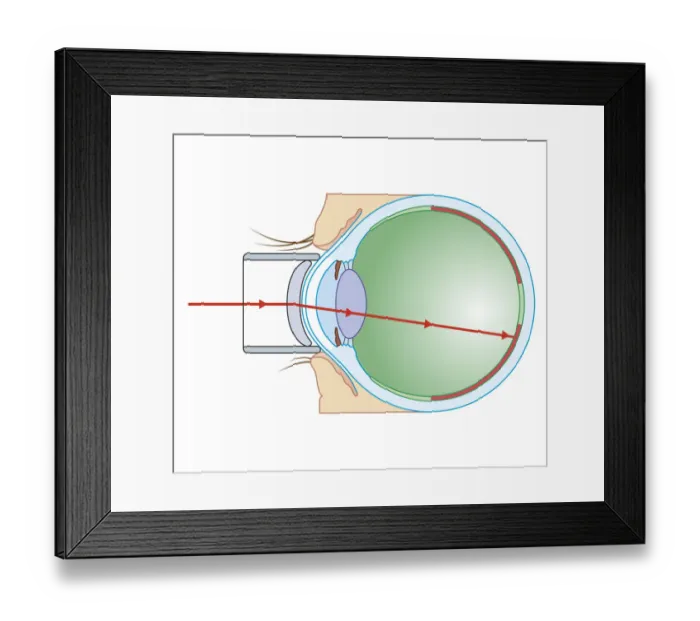 Framed Print : Cross section biomedical illustration of laser surgery for retinopathy Framed Print : Cross section biomedical illustration of laser surgery for retinopathy