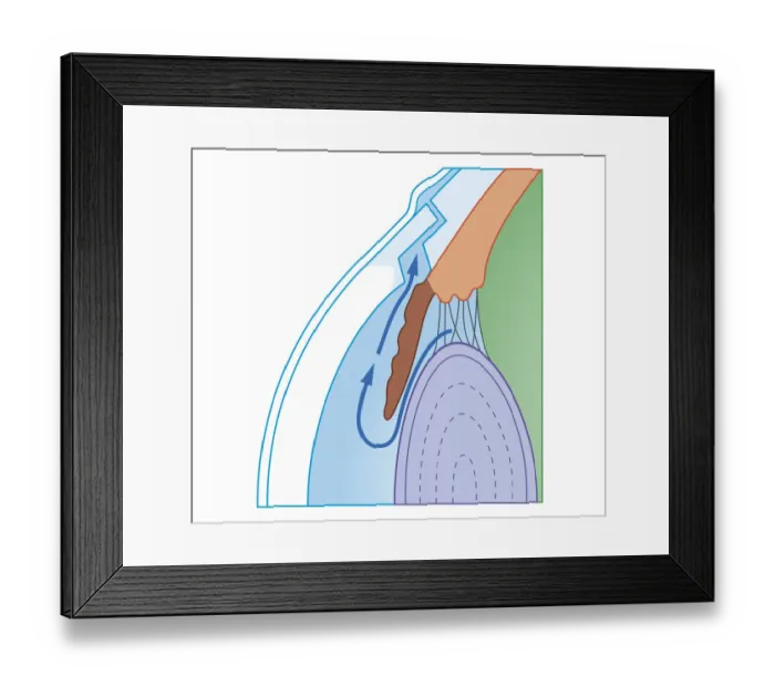 Framed Print : Cross section biomedical illustration of Trabeculectomy procedure to treat glaucoma by relieving Intraocular pressure Framed Print : Cross section biomedical illustration of Trabeculectomy procedure to treat glaucoma by relieving Intraocular pressure