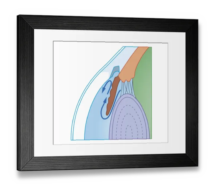 Framed Print : Cross section biomedical illustration of fluid flow in chronic glaucoma Framed Print : Cross section biomedical illustration of fluid flow in chronic glaucoma