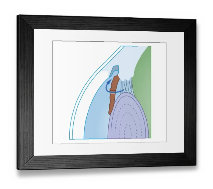 Framed Print : Cross section biomedical illustration of laser iridectomy treatment technique for acute glaucoma Framed Print : Cross section biomedical illustration of laser iridectomy treatment technique for acute glaucoma