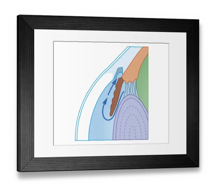 Framed Print : Cross section biomedical illustration of Trabeculectomy procedure to treat glaucoma by relieving Intraocular pressure Framed Print : Cross section biomedical illustration of Trabeculectomy procedure to treat glaucoma by relieving Intraocular pressure