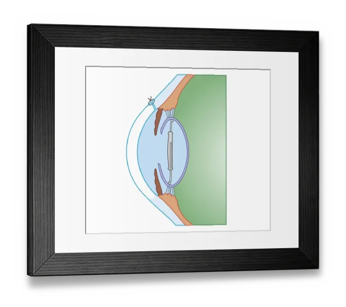Framed Print : Cross section biomedical illustration of cataract surgery Framed Print : Cross section biomedical illustration of cataract surgery