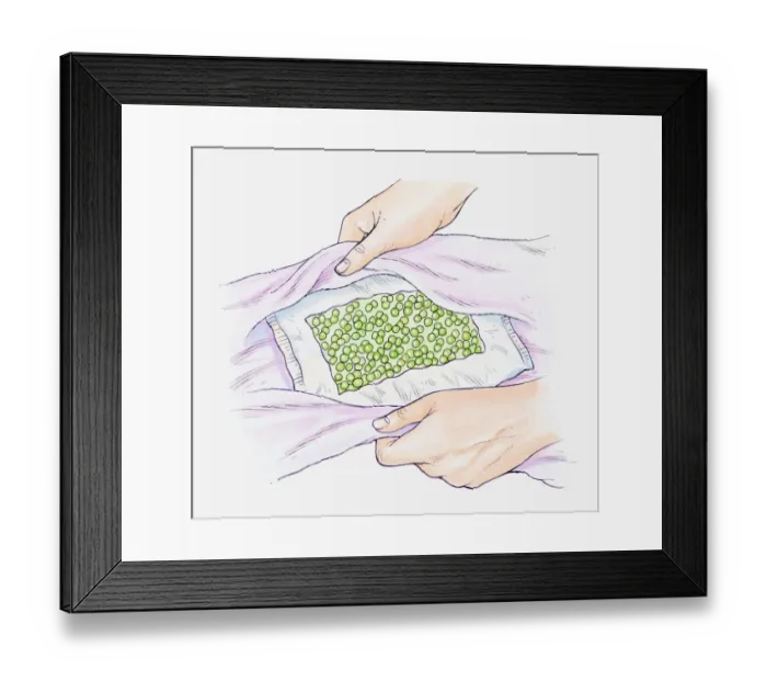 Framed Print : Illustration of a pack of frozen peas being wrapped in a towel to use as a cold compress Framed Print : Illustration of a pack of frozen peas being wrapped in a towel to use as a cold compress
