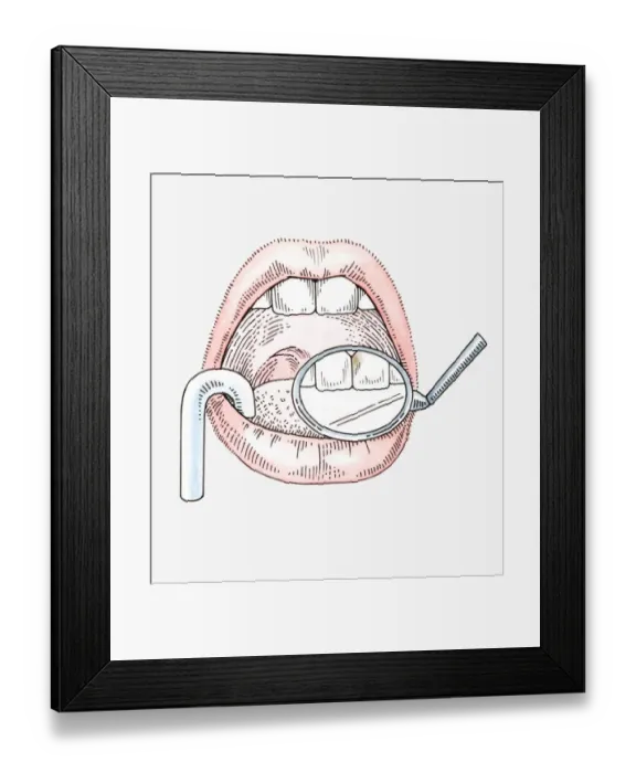 Framed Print : Illustration of dental examination using mirror and suction tube Framed Print : Illustration of dental examination using mirror and suction tube
