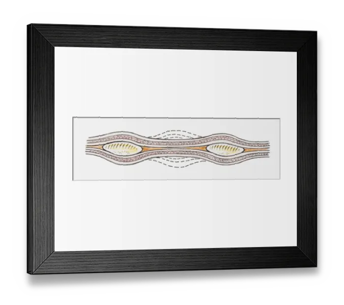 Framed Print : Illustration of contractions of muscles in the wall of the oesophagus (peristalsis) Framed Print : Illustration of contractions of muscles in the wall of the oesophagus (peristalsis)