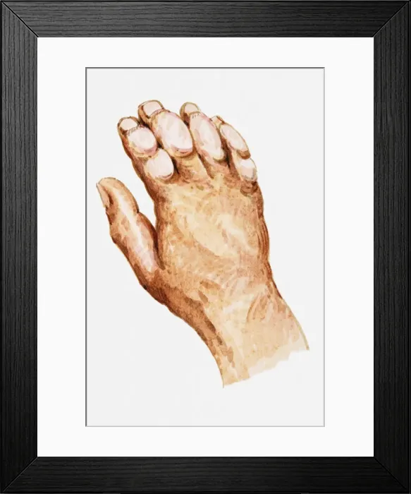 Framed Print : Illustration of hand showing frostbite