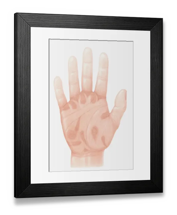 Framed Print : Illustration of accu-pressure points on palm of human hand Framed Print : Illustration of accu-pressure points on palm of human hand